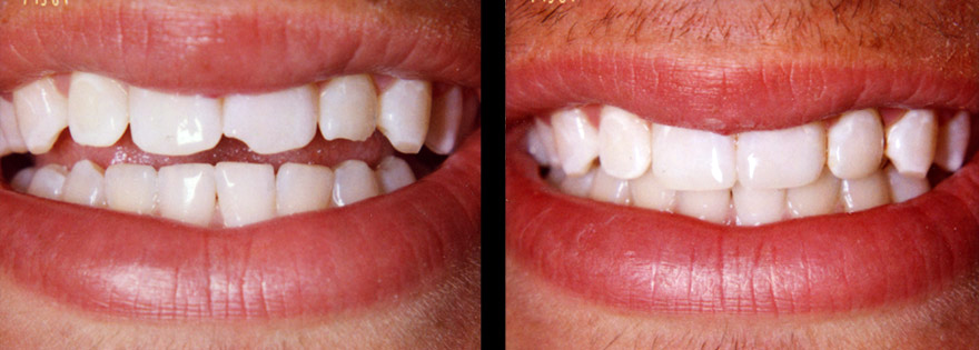 cosmetic dentistry glasgow, composite bonding