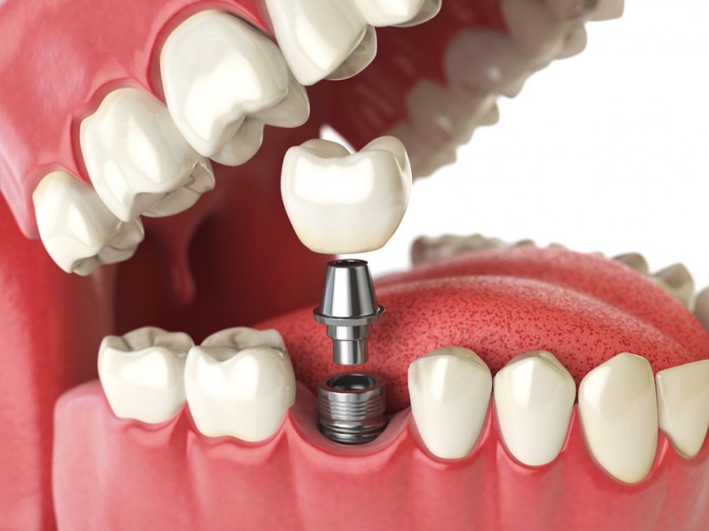 cosmetic dentistry, dental implants