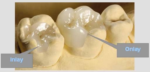 cosmetic dentistry, inlays and onlays 