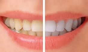 cosmetic dentistry, teeth whitening 