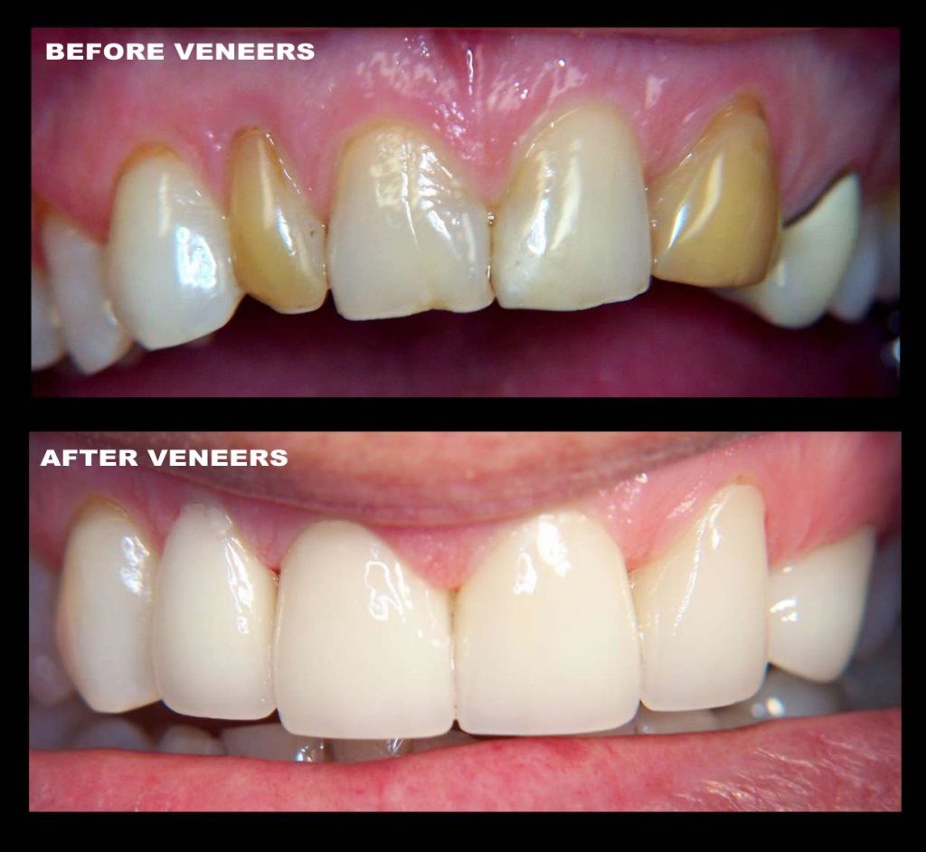 cosmetic dentistry, veneers 